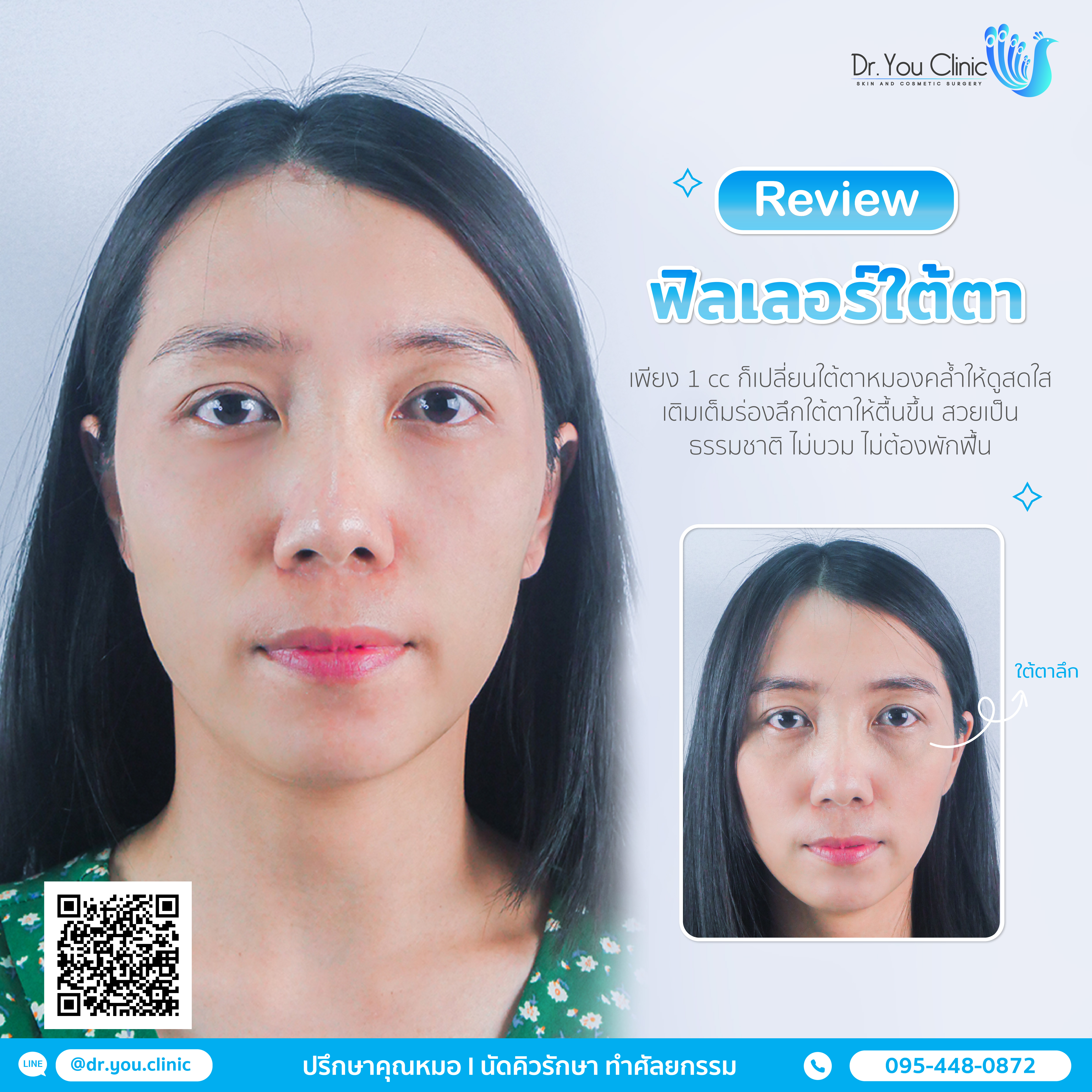 รีวิวฟิลเลอร์ใต้ตา