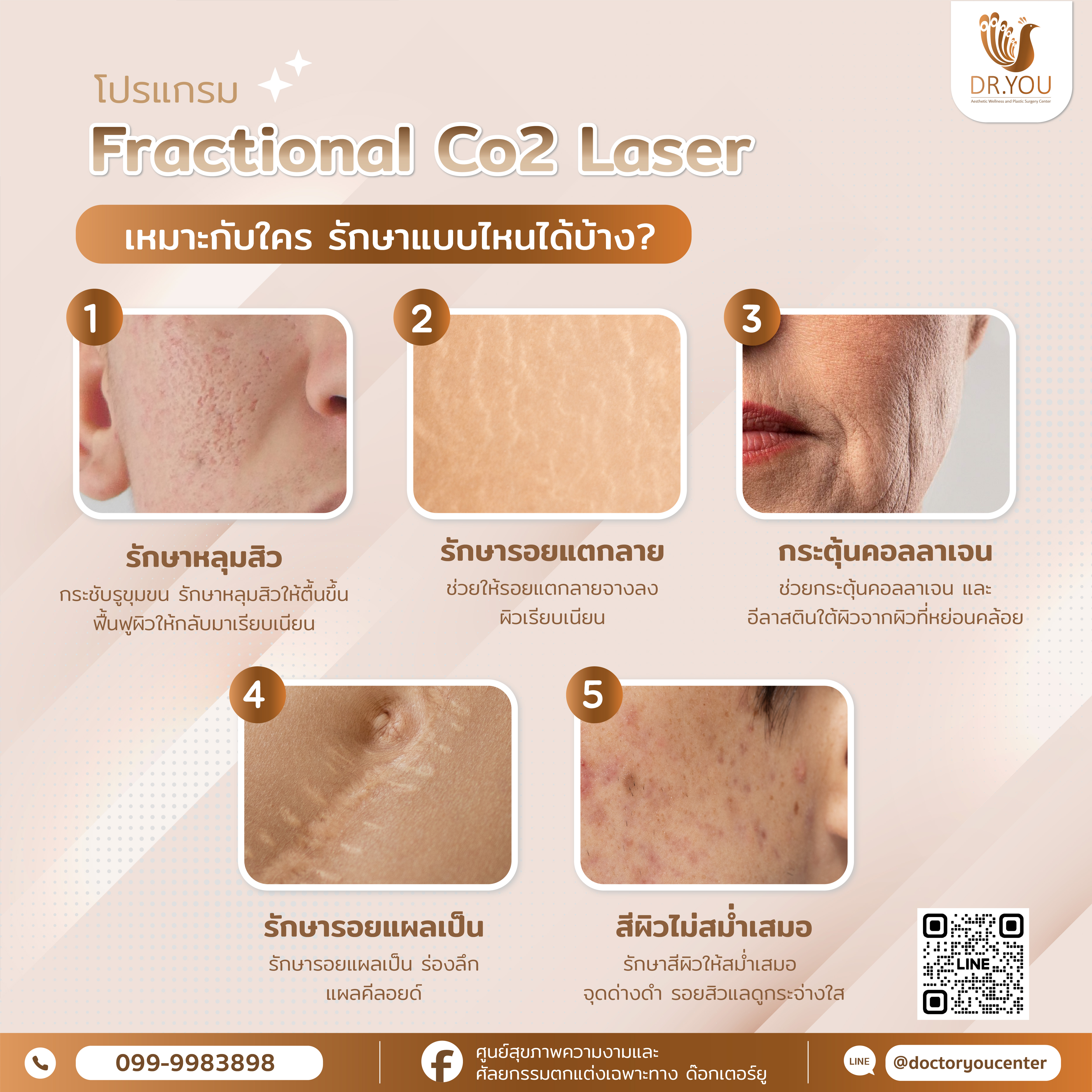 โปรแกรม Co2 Laser เหมาะกับใคร รักษาแบบไหนได้บ้าง