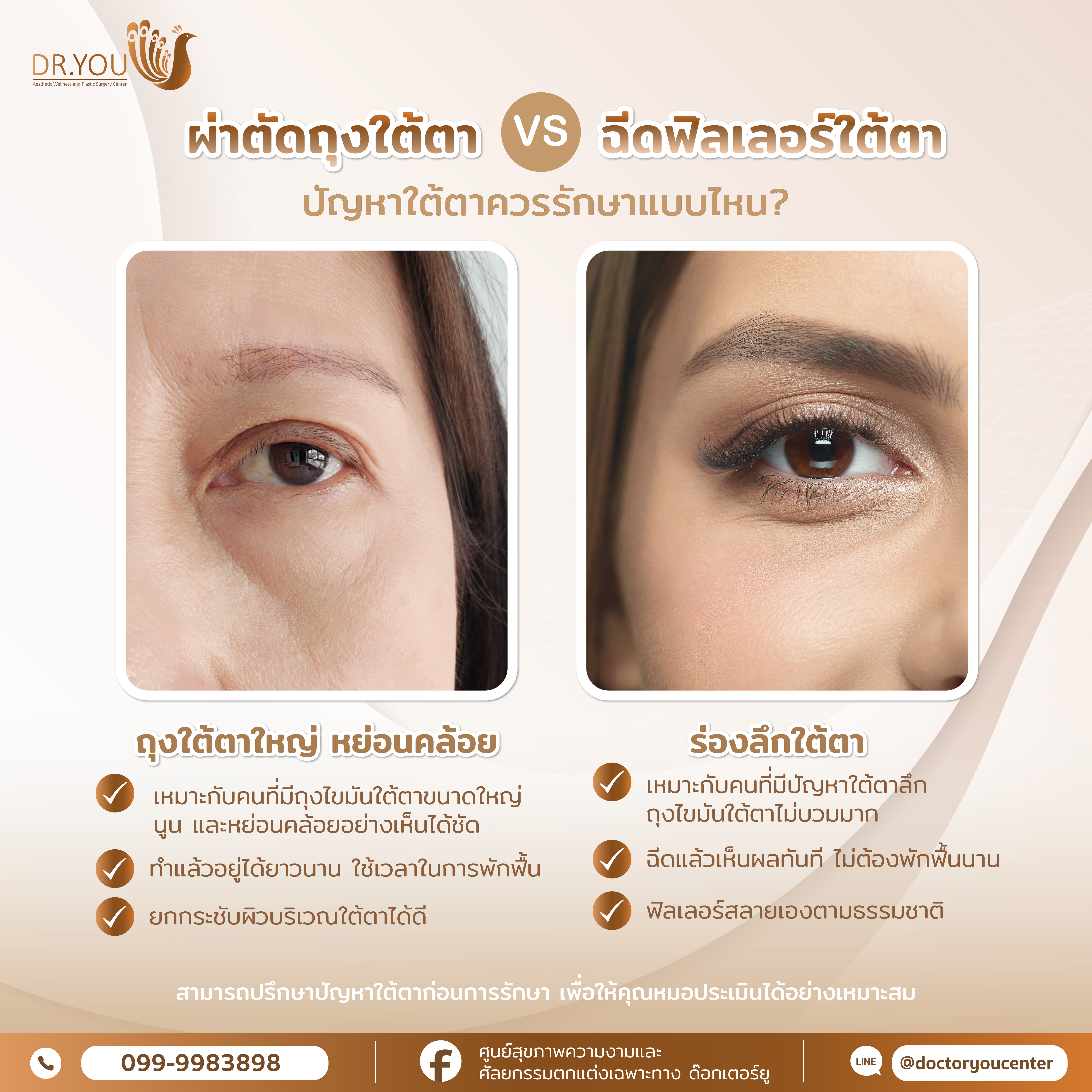 ผ่าตัดถุงใต้ตา VS ฉีดฟิลเลอร์ใต้ตา